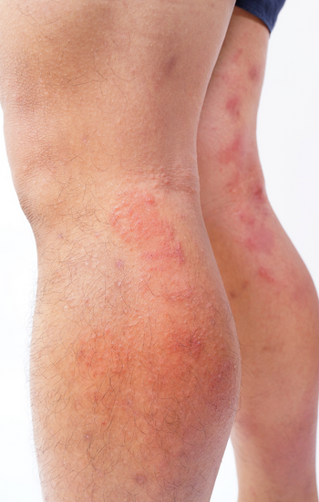 Waden, Knie und Oberschenkel mit sichtbaren Hautrötungen, Ekzemen, Ralife zur Behandlung von Hautproblemen